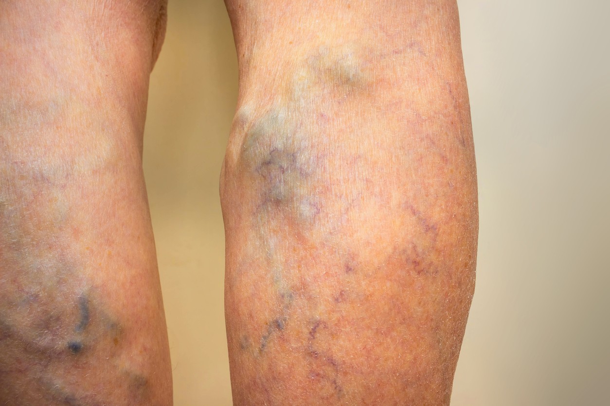 Vein Doctors: What Treatments Should We Expect From This